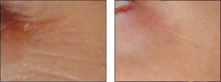 AlwaysYoung Stem Cell Mask Therapy Before and After - Eyes