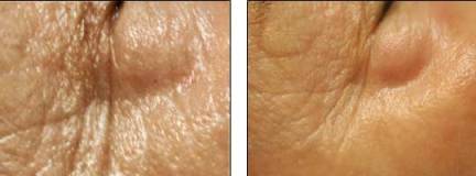 AlwaysYoung Stem Cell Mask Therapy Before and After - Eyes