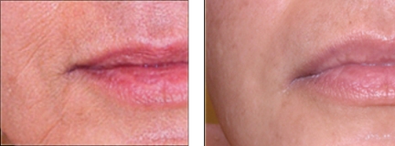 AlwaysYoung Stem Cell Mask Therapy Before and After - Lips